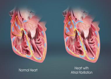 What is atrial fibrillation?